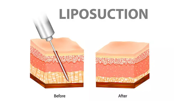 لیپو ساکشن چیست؟